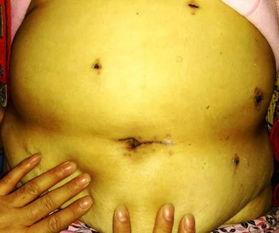 华西胃肠外科吃瓜,揭秘胃肠疾病治疗前沿